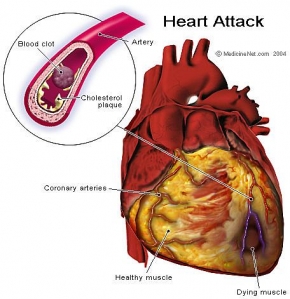 sakit jantung jantung koroner, jantung, gambar jantung, tentang jantung, jantung hati, artikel jantung, terapi jantung, kanker jantung, jantung adalah, komplikasi jantung, diet jantung, gejala jantung, penyebab jantung, serangan jantung, jenis jenis penyakit jantung, jantung lemah, definisi jantung, pengertian jantung, ciri ciri sakit jantung, jantung anak, penyakit jantung rematik, ciri sakit jantung, kateterisasi jantung, transplantasi jantung, ciri penyakit jantung, jantung bengkak, menghujam jantung, jantung berdetak, pembekakan jantung, persarafan jantung, auskultasi jantung, katerisasi jantung, vaskularisasi jantung, dekompensasi jantung, elektrofisiologi jantung, masalah jantung, ring jantung, foto jantung, herbal jantung, jantung aves, video jantung, ecg jantung, pacemaker jantung, jantung ppt, jantung normal, jantung kundalini, stent jantung, jantung membengkak, periksa jantung, penyakit jantung 